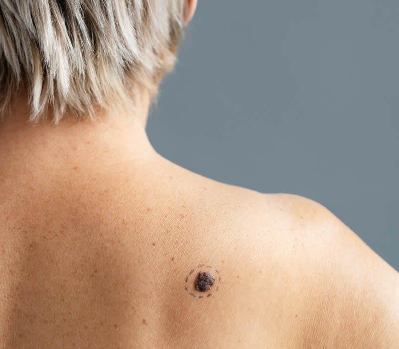 Verrugas, Lunares, Quistes Sebáceos